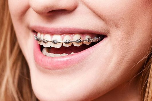 Fixed Metal Braces - Southsid e Orthodontic Clinic